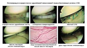 Изображение - Имплант мениска коленного сустава Transplantatsiya-meniska-300x167