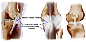 Разрыв сухожилий коленного сустава лечение