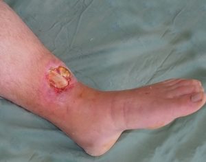 Рваная рана в области коленного сустава