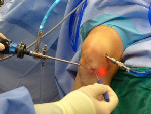 Изображение - Имплант мениска коленного сустава global-knee-cartilage-repair-equipment-market-1-300x226