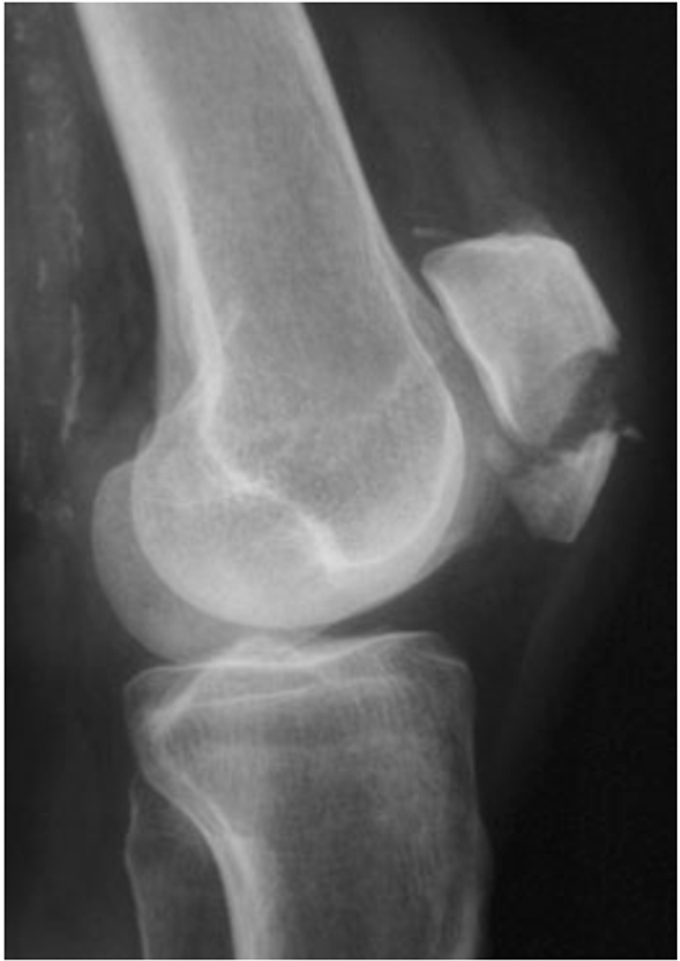 Трещина в коленной. Рентген снимок перелом надколенника. Рентген коленного перелом надколенника. S82. 0 Перелом надколенника. Перелом надколенника рентген.