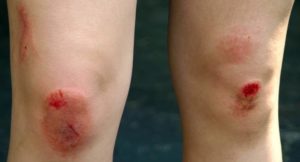 Рваная рана в области коленного сустава