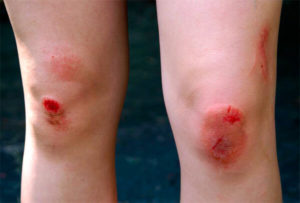 Как быстро вылечить болячки на коленках