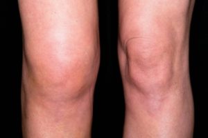 Лечение миозита коленного сустава