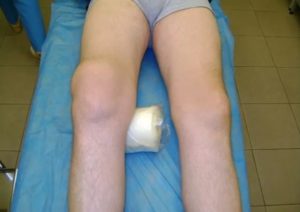 Изображение - Синовит коленного сустава у ребенка симптомы лечение sinovit-na-noge-300x212