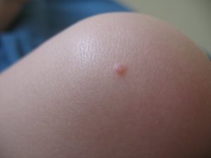 Бородавка на коленке у ребенка фото