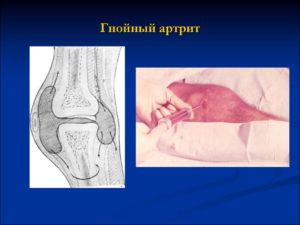 Гнойный артроз коленного сустава лечение
