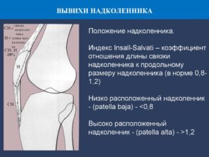 Лечение вывиха коленного сустава: как вправить, причины и признаки, код МКБ-10. Симптомы вывиха коленного сустава и методы восстановления