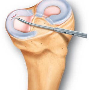 Трещина коленного сустава лечение в домашних thumbnail