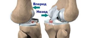 Блокировка коленного сустава при артрозе