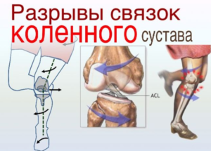 Сухожилия и связки в колене