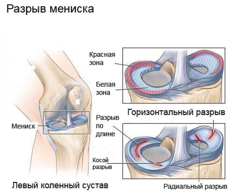 Картина раздавленного медиального мениска