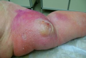 Рожистое воспаление коленного сустава ноги