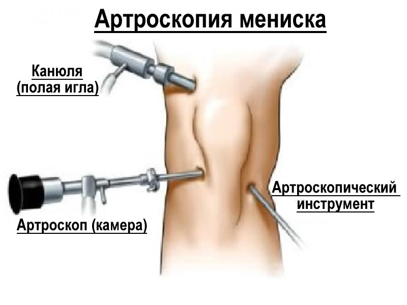 Удалить мениск колена. Операция на разрыв мениска артроскопия. Артроскопия коленного сустава разрыв мениска. Артроскопия ПКС коленного сустава. Артроскопия мениска осложнения.