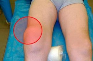 Лечение невропатии коленного сустава