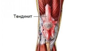 Болит коленный сустав при долгом сидении thumbnail