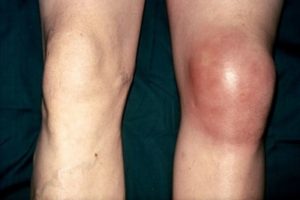 Застарелая гематома в колене