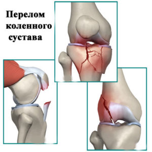 Как разработать ногу после перелома колена и гипса упражнения ЛФК для восстановления и реабилитации