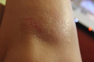 У ребенка 4 месяца сухая кожа на коленях thumbnail