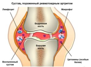 Ревматизм коленного сустава лечение thumbnail