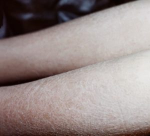 Причины шелушения кожи икр ног