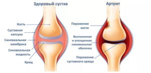Изображение - Простуда коленных суставов Artrit-kolennogo-sustava3-300x146