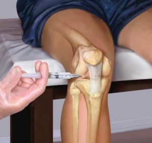 Пункция при гематоме колена