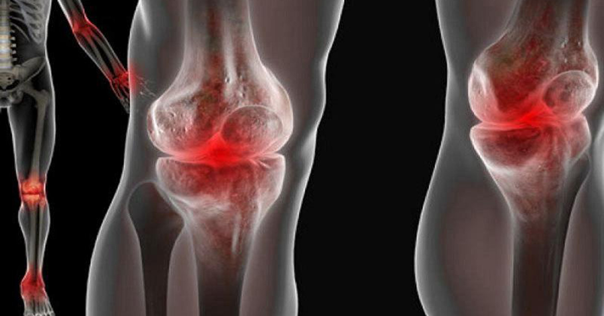 Гонартроз коленного сустава 3-4 степени: перспективы больного