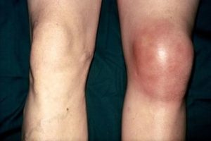 Рожистое воспаление коленного сустава ноги thumbnail