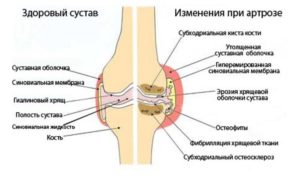 Артроз коленного сустава genutrain