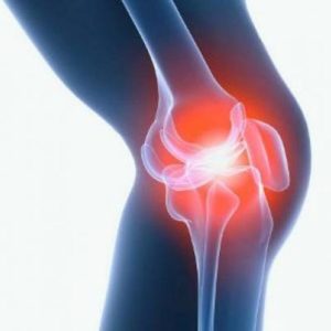 Невралгия коленного сустава симптомы и лечение