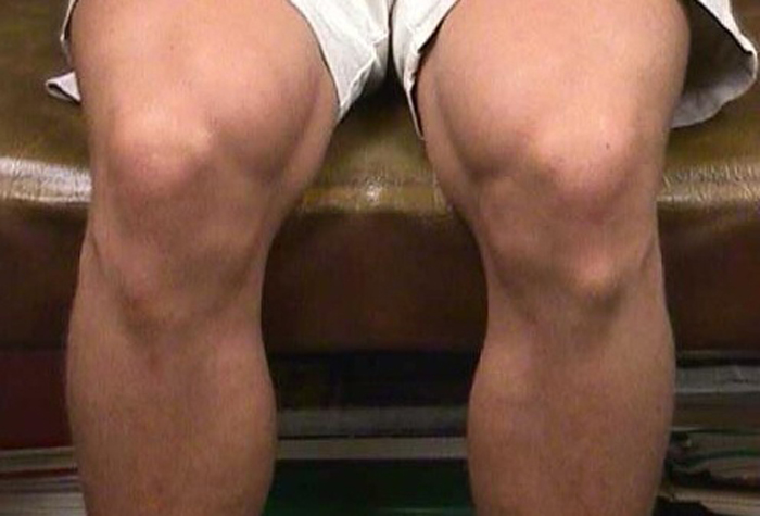 Уплотнение в виде шарика под кожей на ноге выше колена