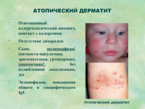 Шелушение кожи под коленками у ребенка