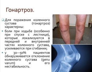 Гонартроз коленного сустава 3-4 степени: перспективы больного