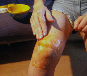 Боли в коленях: лечение в домашних условиях. Народные средства для лечения коленных суставов