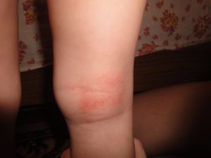 Красные пятна под коленками у ребенка 2 года