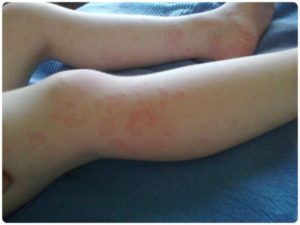 Покраснение кожи и зуд под коленом у взрослых и детей причины заболеваний и методы лечения