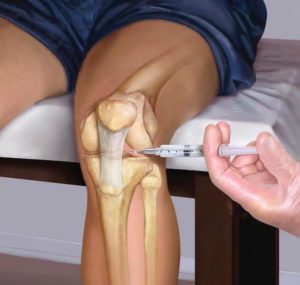Дипроспан отзывы при артрозе коленного сустава