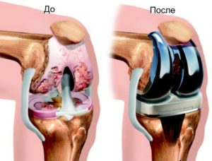 Виды и способы проведения артропластики коленного сустава