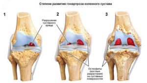 После артроскопии коленного сустава отекает колено