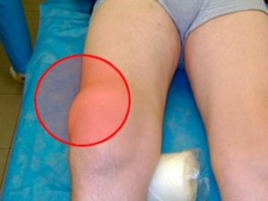 Отек коленного сустава причины симптомы диагностика лечение