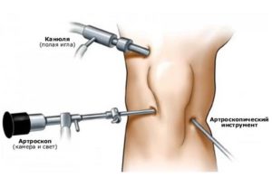 Последствия артроскопии коленного сустава боль отек контрактура колена