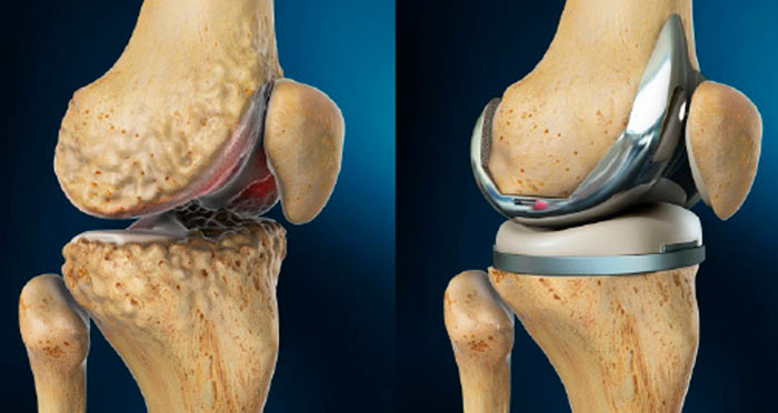 Эндопротезирование коленного сустава картинки