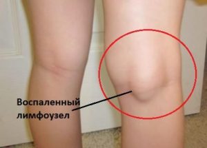 Болит лимфоузел на ноге колено