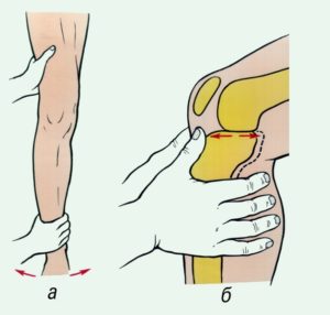 Как лечить привычный вывих коленного сустава