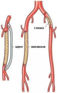 Атеросклероз окклюзия бедренно подколенного сегмента