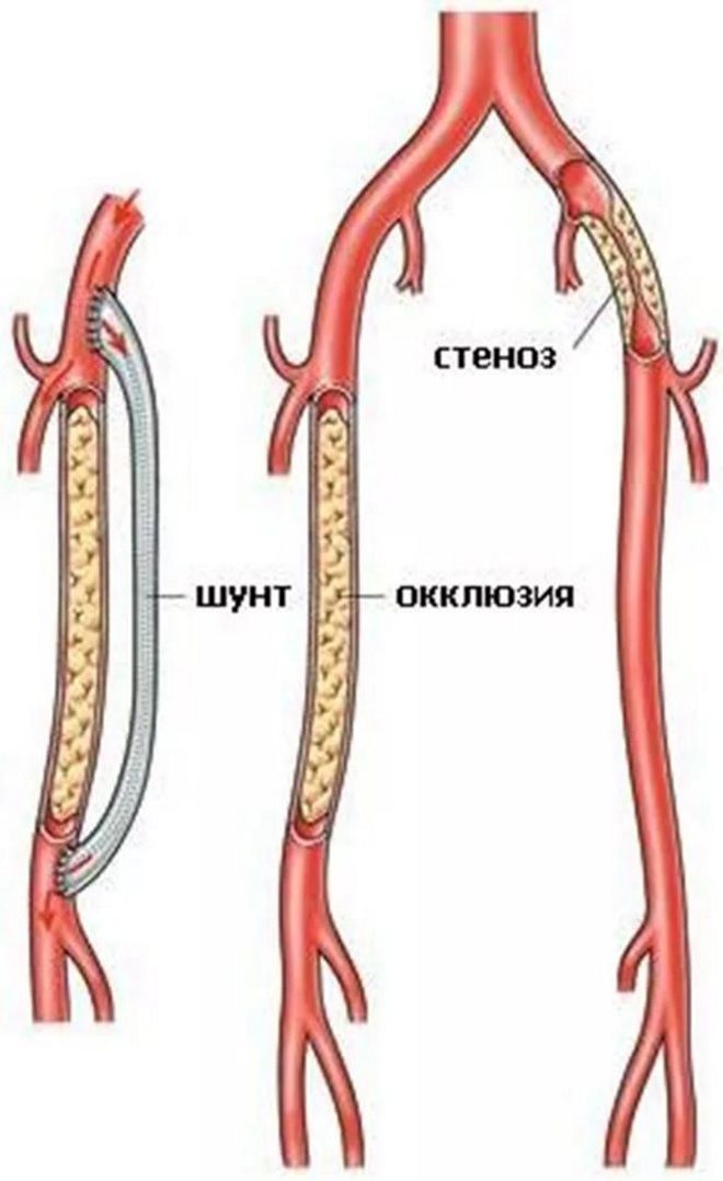 Как выглядит шунт. Шунт артерии нижних конечностей. Аорто бедренное шунтирование. Коронарное шунтирование сосудов сердца. Шунтирование артериального сосуда.