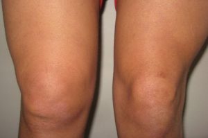Отек коленного сустава без боли: симптомы, причины и лечение у женщин в домашних условиях