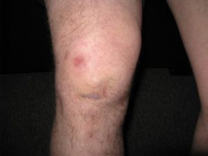 Болит колено после ушиба спустя месяц
