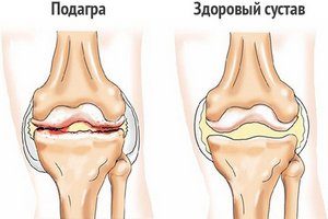 Артралгия коленного сустава код мкб